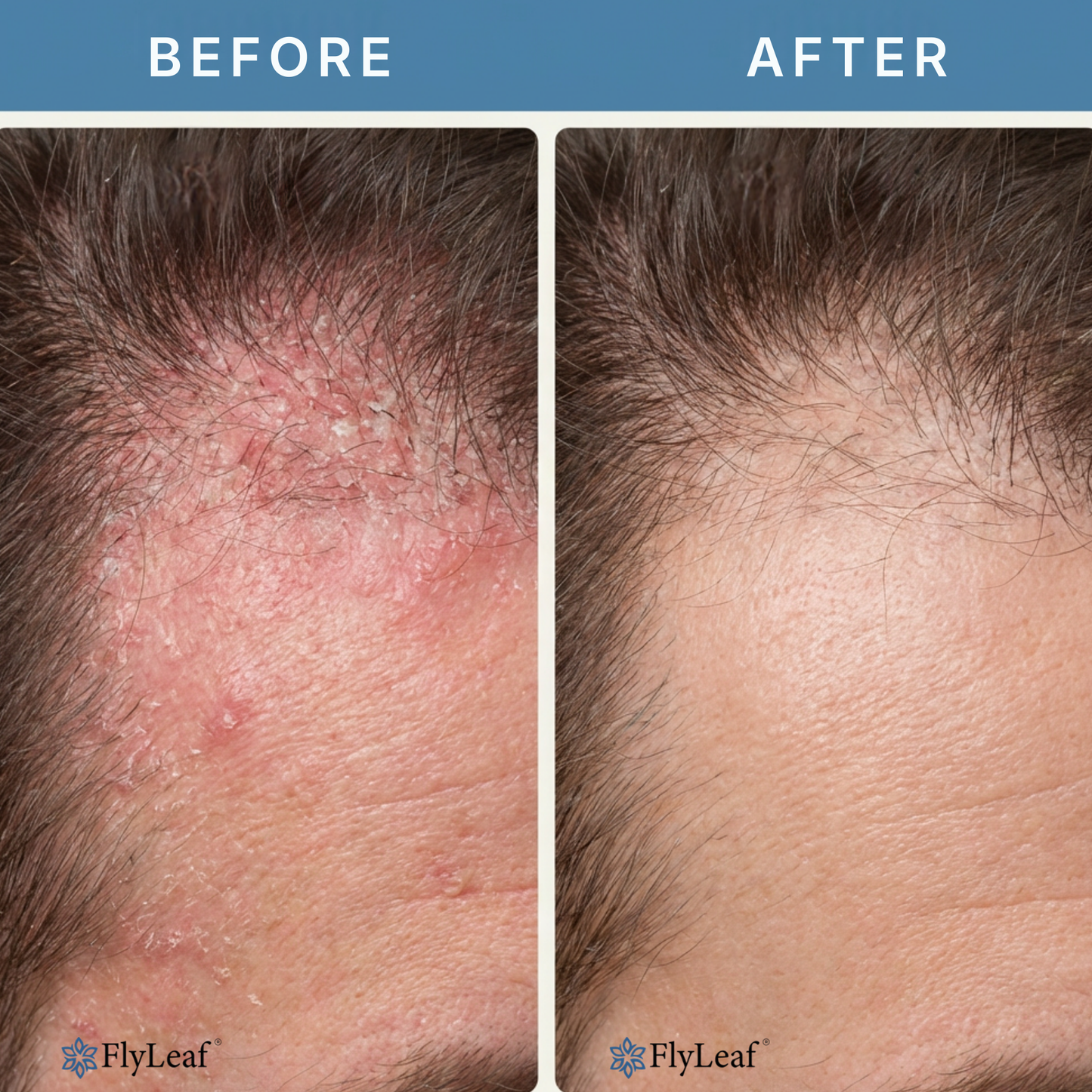 Flyleaf®  Visible Beard & Scalp Relief in 7 Days Without Steroids